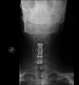 Corporectomía cervical C5 (AP)