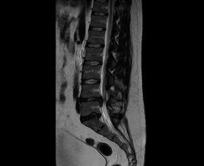Estenosis de Canal lumbar secundario a hernia de disco extruída L4L5