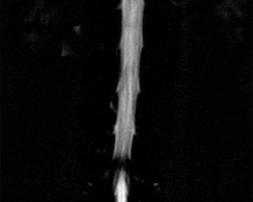 Estenosis-de-Canal-lumbar-1