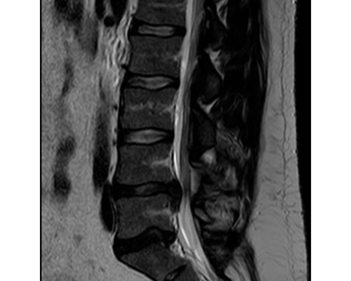 Estenosis-de-Canal-lumbar-secundario-a-hernia-de-disco-extruída-L4L5-1