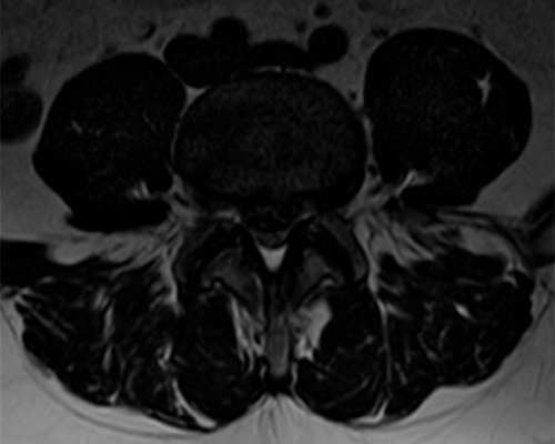 Estenosis-de-canal-lumbar-L4L5-secundario-a-Hernia-de-disco-1