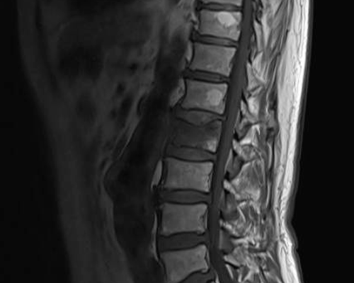 Fractura-aplastamiento-de-L2-secuencia-T1