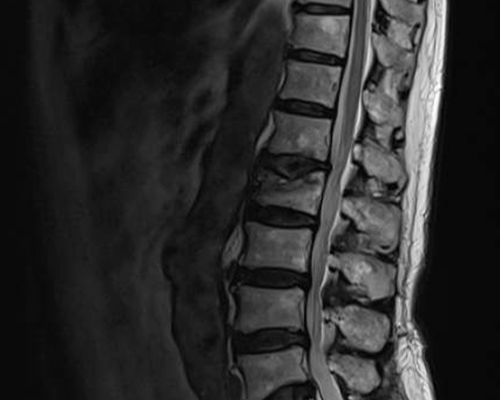 Fractura-aplastamiento-de-L2-secuencia-T2