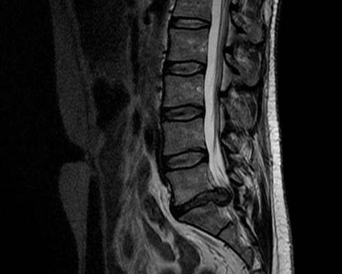 Hernia-de-disco-L5S1-extruída-1