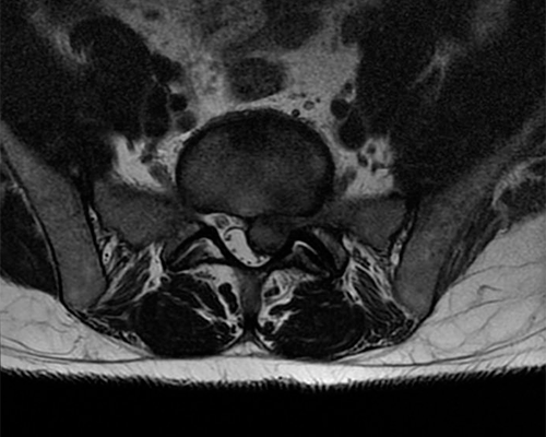 Hernia-de-disco-L5S1-izquierda-1