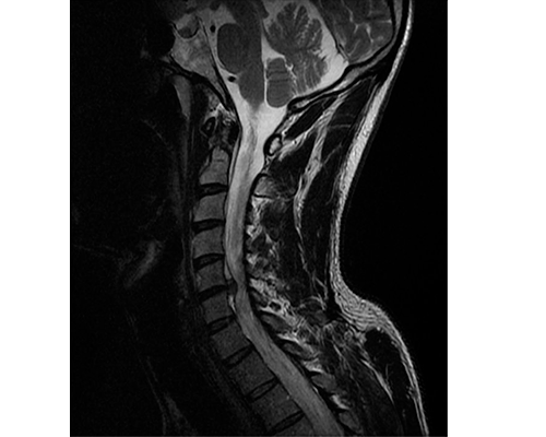 Hernia-disco-cervical-C5C6